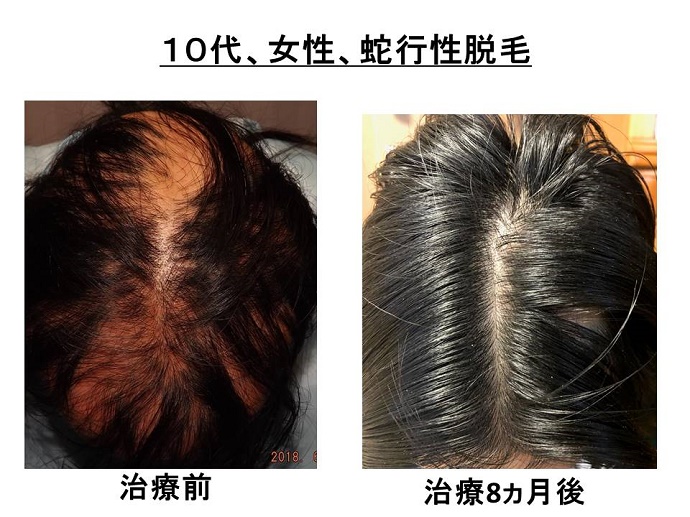 円形脱毛症　病院